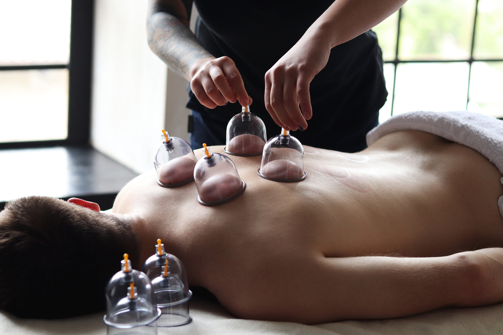cupping therapy in Preston