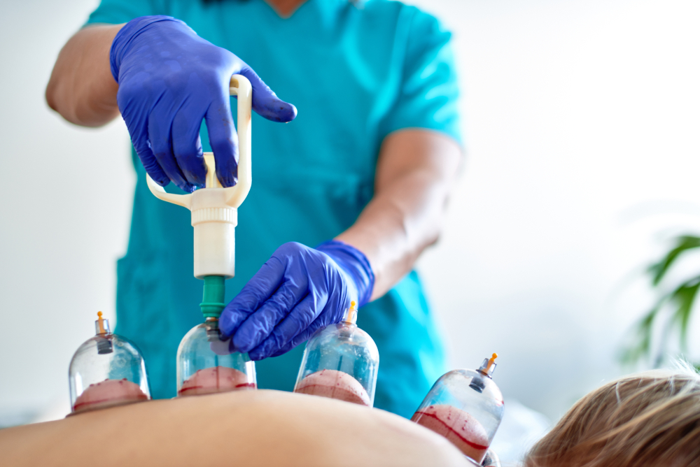 hijama cupping in Preston