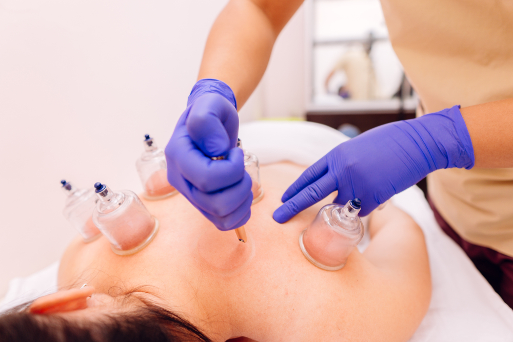 hijama cupping